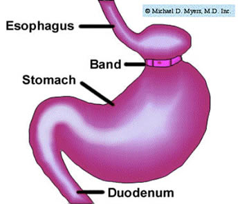 a drawing showing a band constricting the stomach to decrase the amount of food that can be consumed