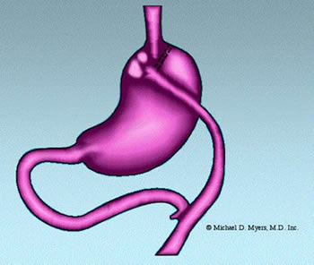 a drawing followed by a brief movie showing how the stomach and small intestine are transected and then a portion of the intestine is brought up to a small pouch that is the remainder of the stomach